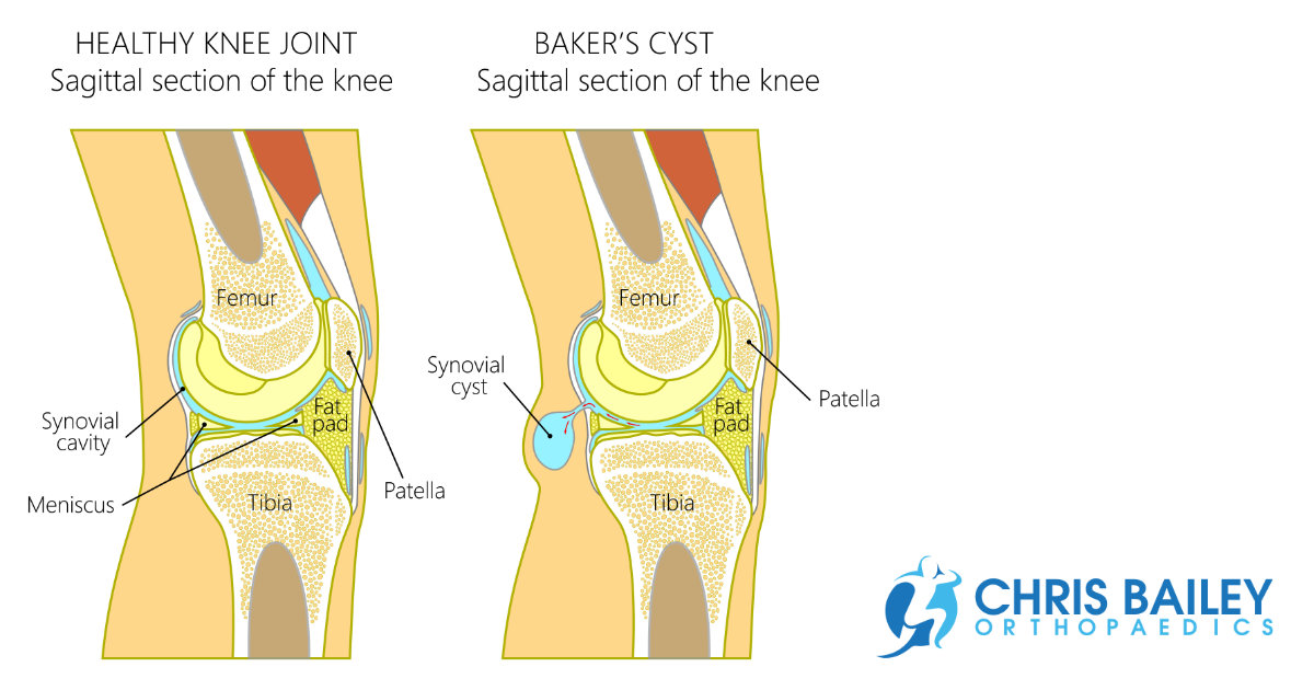 View 28 Baker s Cyst Knee Ultrasound